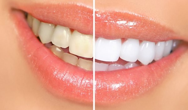 clareamento-dental-dentista-em-londrina